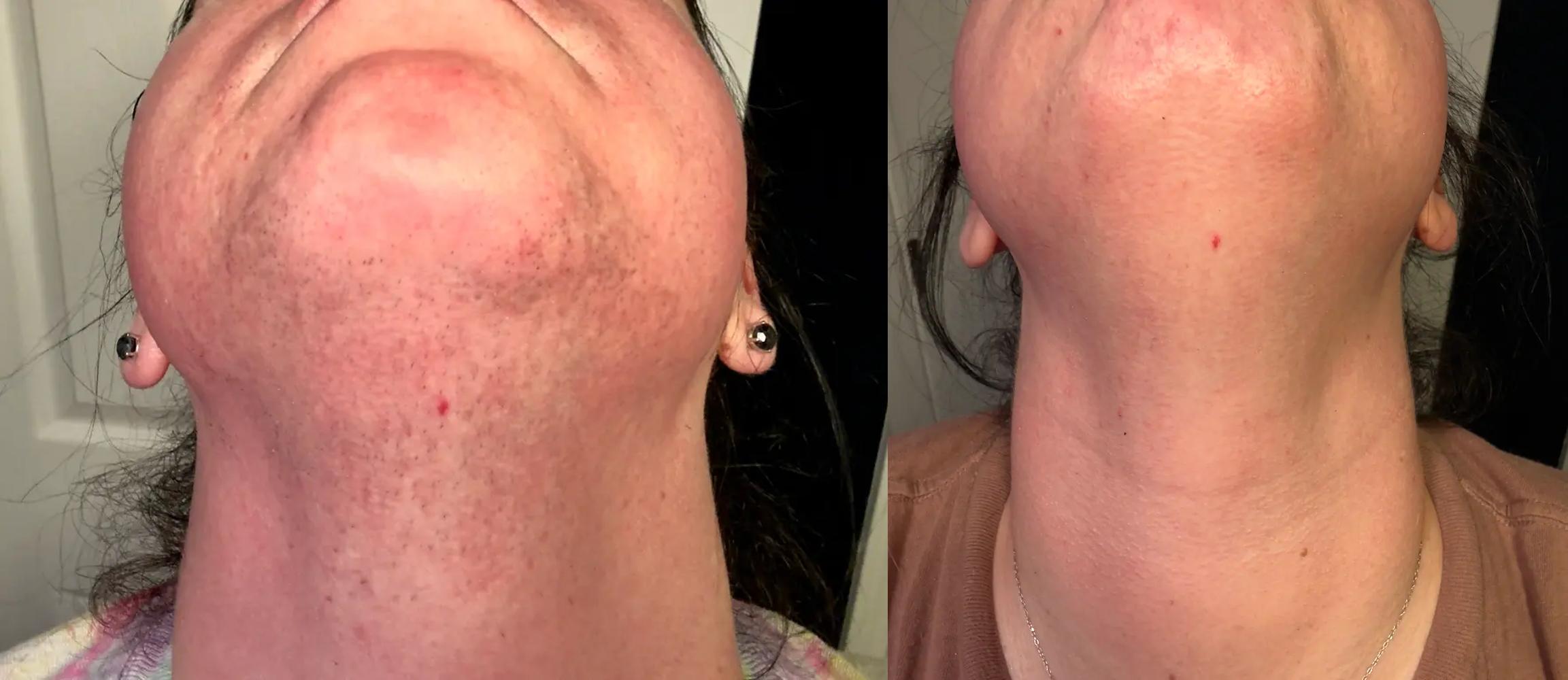 before-after-biovive-face.jpg